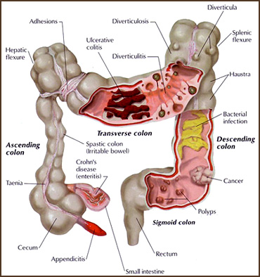 The Benefits of Colon Cleansing. healthy intestinal flora, colon cleansing, 
