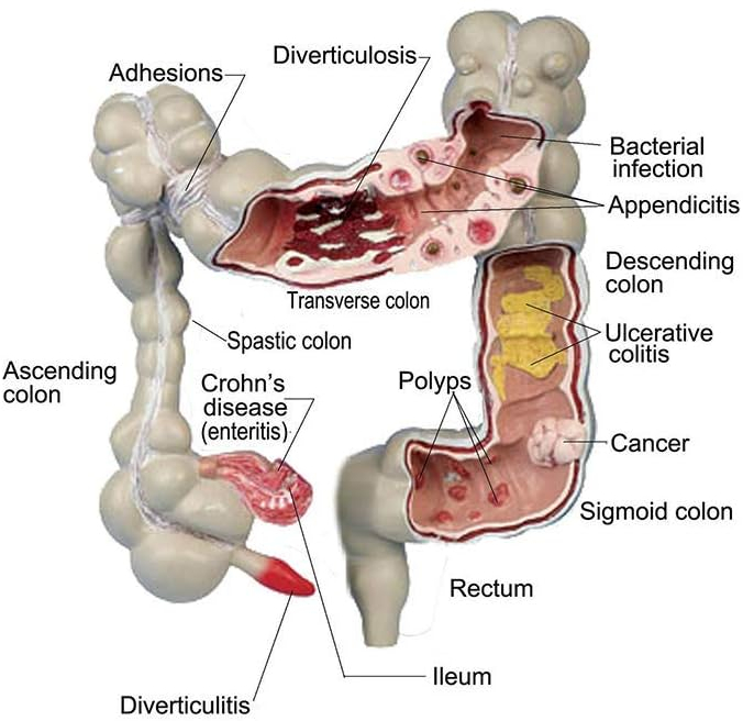 The Benefits of Colon Cleansing. healthy intestinal flora, colon cleansing, 